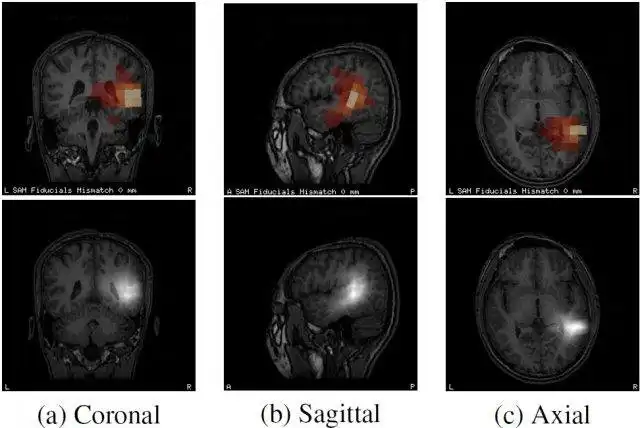 ওয়েব টুল বা ওয়েব অ্যাপ CTF-SAM-OUT, সুপারপোজিং CTF SAM এবং MRI ডাউনলোড করুন